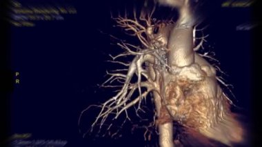 Pulmoner arter ile CTA torasik aort 3D görüntüleme ekran etrafında dön.