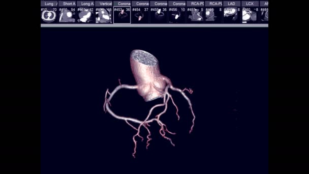 Cta Coronary Artery Rendering Image Coronary Tree Turn Screen Diagnosis — Stockvideo