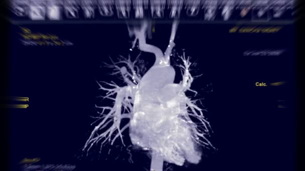 Cta Mellkasi Aorta Renderelés Pulmonalis Artéria Mip Technika Viszont Képernyőn — Stock videók