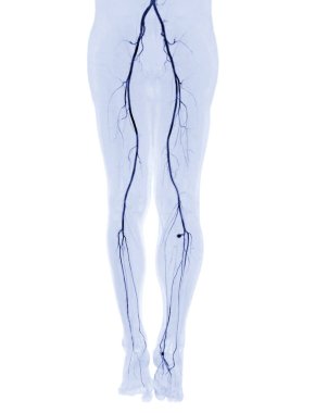 CTA femoral artery run off  3D MIP image  of femoral artery for diagnosis Acute or Chronic Peripheral Arterial Disease and femoral artery injury. clipart