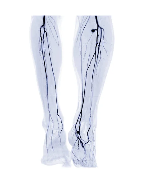 Cta Femoral Artery Run Mip Image Cta Leg Diagnosis Akutní — Stock fotografie