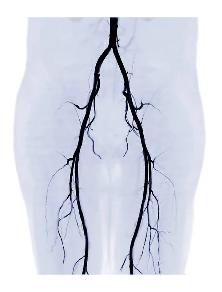 Cta大腿骨動脈は 診断のための大腿骨動脈の3D Mip画像をオフに実行急性または慢性末梢動脈疾患や大腿骨動脈損傷 — ストック写真