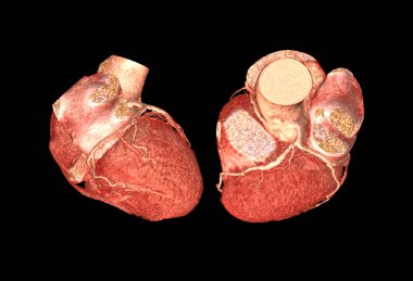 CTA koroner arterinin üst görüntüsü. 3D görüntüleme. Koroner arter hastalığını bulmak için siyah zemin izole edildi..
