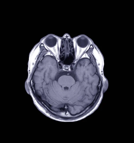 脳のMri軸T1ビューは このような嚢胞 黒の背景に隔離された出血 出血などの脳の様々な条件を検出するために クリッピングパス — ストック写真