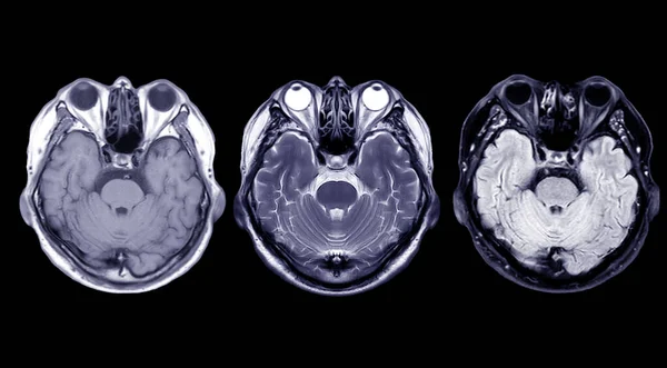 脳のMriを比較する軸T1 T2脳のさまざまな状態 黒い背景に隔離された出血 出血など を検出するための平面図 — ストック写真