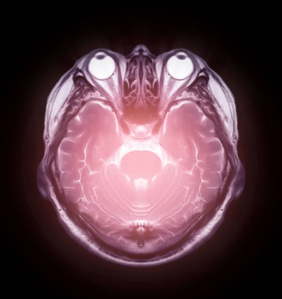 Mri Mózgu Osiowy Widok Wykrywania Różnych Warunków Mózgu Takich Jak — Zdjęcie stockowe