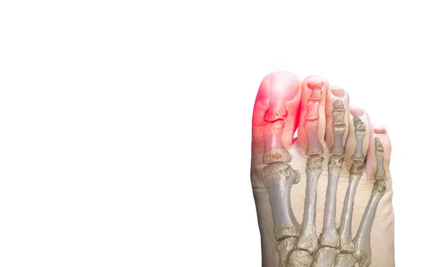 Close Left Foot Bone Show Pain Area Isolated White Background — Stock Photo, Image