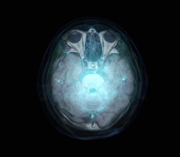 Gambar Transparan Dari Skull Biru Dengan Brain Untuk Konsep Latar — Stok Foto