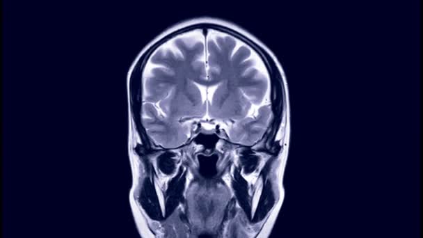 Mrt Gehirn Oder Magnetresonanztomographie Coronal T2W View — Stockvideo