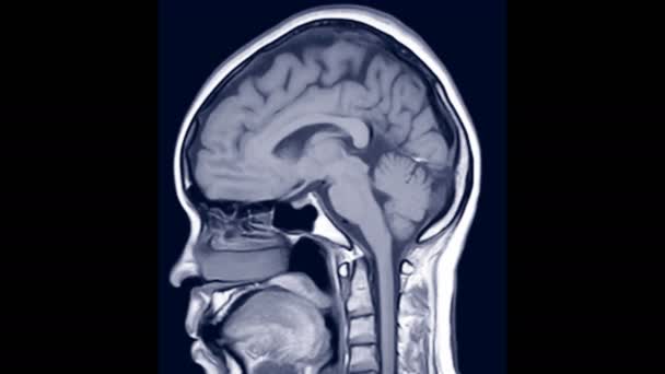 Мрт Мозга Сагиттальном Показывающее Анатомию Мозга — стоковое видео