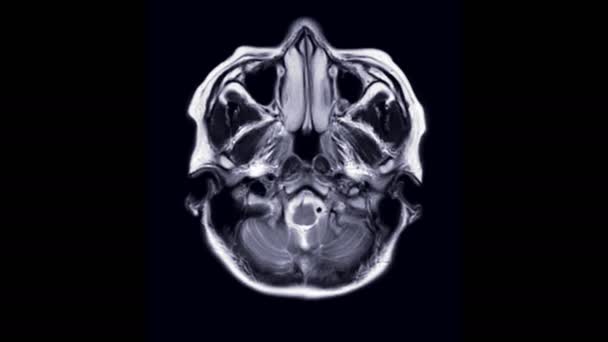 สมอง Mri อภาพสะท อนแม เหล กในแกน T2W — วีดีโอสต็อก