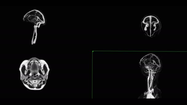 Comapre Mrv Brain Oder Magnetresonanzvenographie Des Gehirns Axial Und Mip — Stockvideo