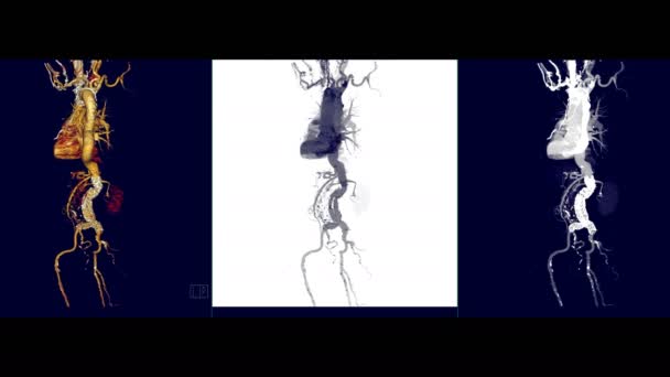 Cta Tüm Aort Görüntüleme Anjiyografi Mip Karşılaştırın Aort Diseksiyonu Veya — Stok video