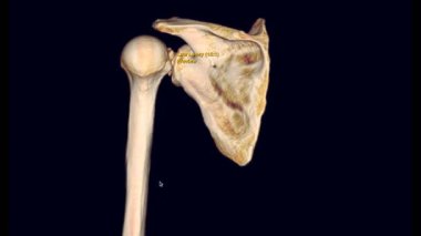 Tomografide sol omzun 3D görüntülemesi kol kemiğinin kırık olduğunu gösteriyor. .