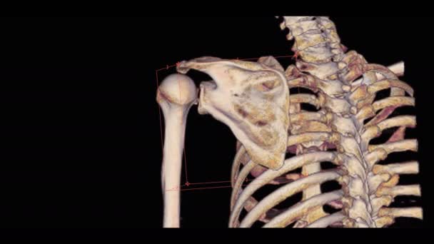 Scan Weergave Van Linker Schouder Met Fractuur Hoofd Van Opperarmbeen — Stockvideo