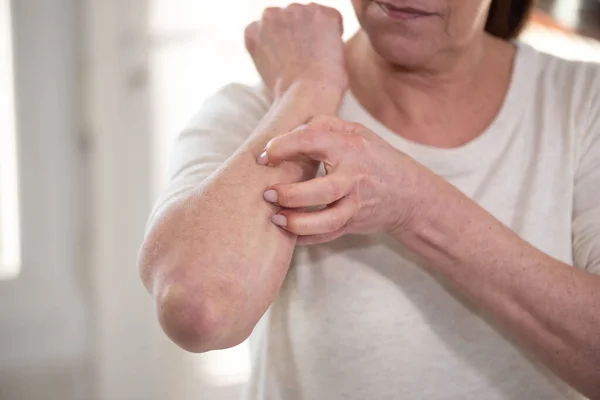 Woman Having Itchy Scratching Her Arm Allergy Symptoms — Stock Photo, Image