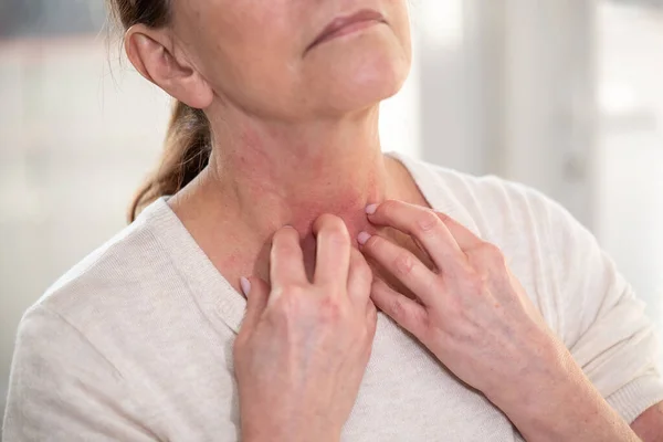 女人发痒 扭伤脖子 过敏症状 — 图库照片