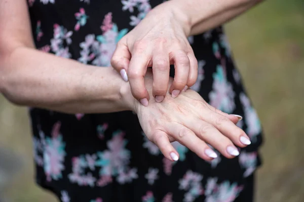 Vrouw Met Jeuk Krabben Haar Hand — Stockfoto