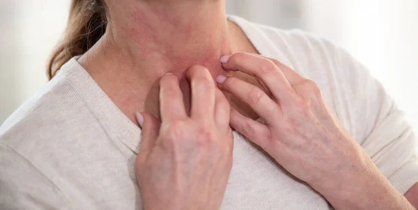 Een Vrouw Met Jeuk Krassen Haar Nek Allergische Symptomen — Stockfoto