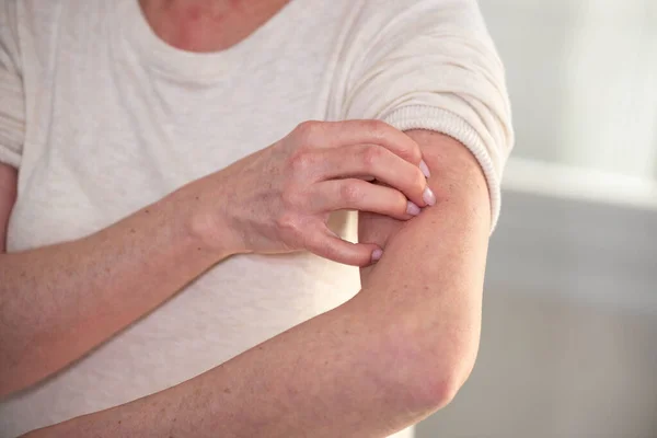 Een Vrouw Die Jeukt Aan Haar Arm Krabt Allergische Symptomen — Stockfoto
