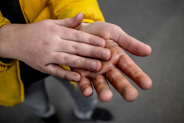 Mani sporche di un adolescente. Condizioni non igieniche. Malattie ed epidemie. Inquinamento. Igiene . — Foto Stock