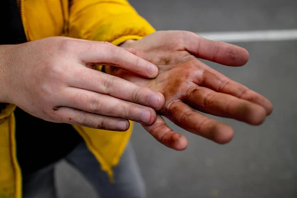 Mãos sujas de um adolescente. Condições insalubres. Doenças e epidemias. Poluição. Higiene . — Fotografia de Stock