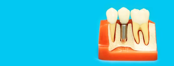 Modelo médico de la mandíbula con dientes postizos en un alfiler sobre fondo azul —  Fotos de Stock