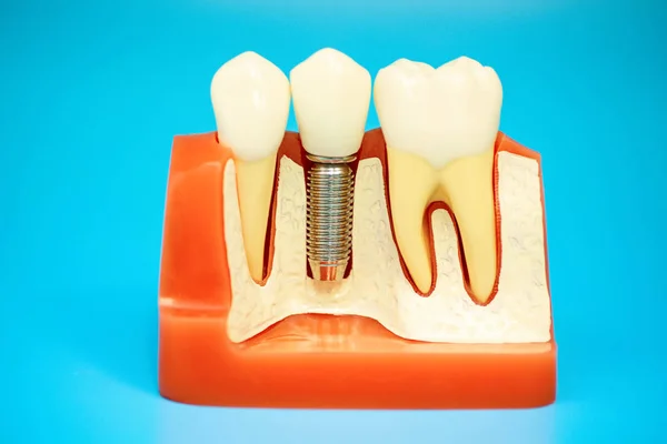 Modelo médico de la mandíbula con dientes postizos en un alfiler sobre fondo azul —  Fotos de Stock