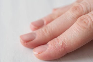 Parmaklarda Kuru Kırık Deri ile Bir Kadının Elinin Kapatılması