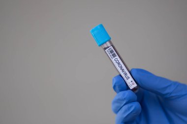2020 'de dünya salgınında yapılan koronavirüs testinin kan örneği. Laboratuvar asistanı covid-19 testi için kan örneği tutuyor..