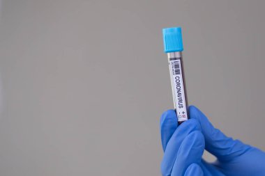 2020 'de dünya salgınında yapılan koronavirüs testinin kan örneği. Laboratuvar asistanı covid-19 testi için kan örneği tutuyor..