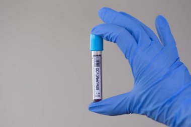 2020 'de dünya salgınında yapılan koronavirüs testinin kan örneği. Laboratuvar asistanı covid-19 testi için kan örneği tutuyor..