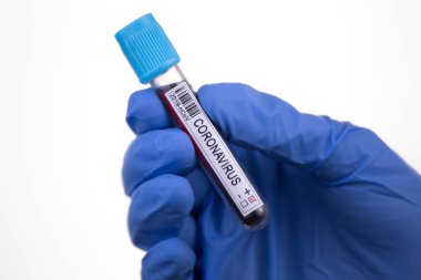 2020 'de dünya salgınında yapılan koronavirüs testinin kan örneği. Laboratuvar asistanı covid-19 testi için kan örneği tutuyor..