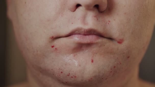 Dorosły mężczyzna używa ostrza, by obciąć sobie brodę podczas zamknięcia kręgosłupa. Zrobił to za pierwszym razem i miał trochę krwi na twarzy. — Wideo stockowe