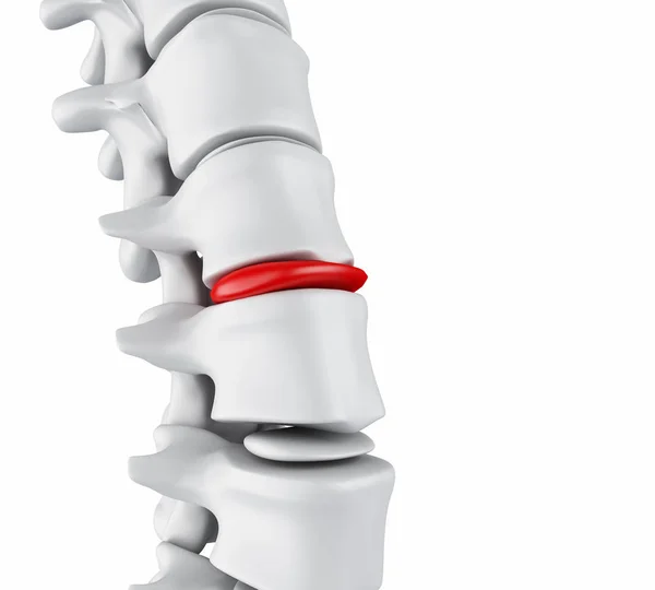 3d Herniated disk concept. — Stock Image 3d Herniated disk concept. Stock Photo