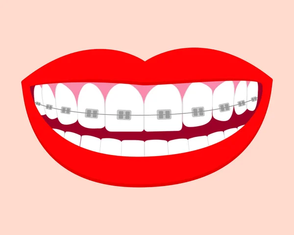 Ağızda Beyaz Diş Telleri Olan Bir Gülümseme Vektör Izole Elementler — Stok Vektör