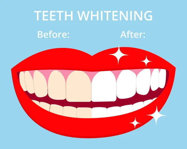 Dentes Whitening Conceito Woth Riu Rato Dentes Antes Depois Branqueamento —  Vetores de Stock