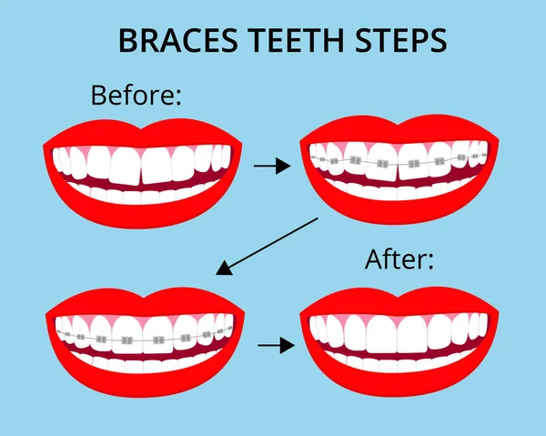Βήματα Ορθοδοντικής Θεραπείας Σιδεράκια Στο Στόμα Χαμόγελο Λευκά Δόντια Πριν — Διανυσματικό Αρχείο