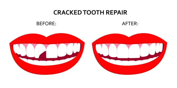 Ilustração Reparação Dentária Fissurada Sorria Boca Com Dente Rachado Antes —  Vetores de Stock