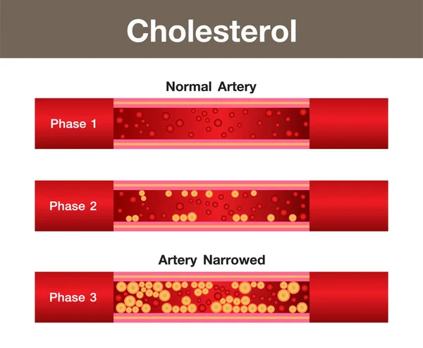 Colesterol Arteria Riesgo Para Salud Diseño Vectores — Vector de stock