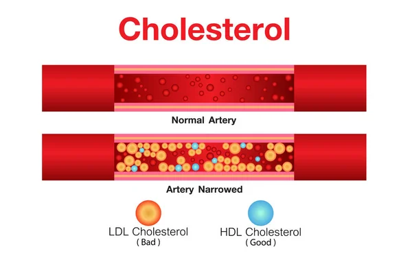 Colesterol Arteria Riesgo Para Salud Diseño Vectores — Vector de stock