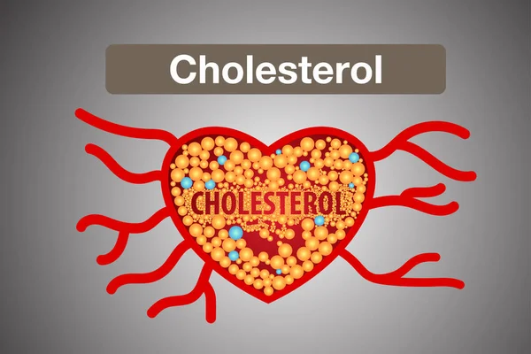 Χοληστερόλη Στην Αρτηρία Κίνδυνος Για Την Υγεία Διανυσματικός Σχεδιασμός — Διανυσματικό Αρχείο