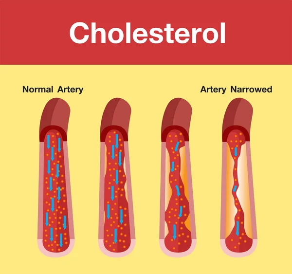Colesterol Artéria Risco Para Saúde Desenho Vetorial — Vetor de Stock