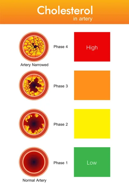 Colesterol Arteria Riesgo Para Salud Diseño Vectores — Vector de stock
