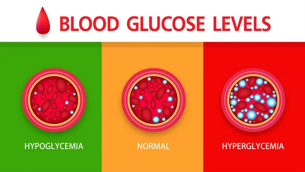 Iperglicemia Glicemia Alta Diabete Obesità Una Grave Condizione Medica Cause — Vettoriale Stock