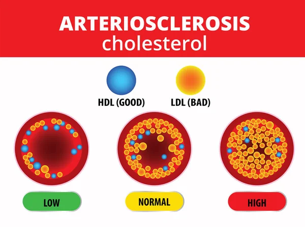Arteriosclerosis Colesterol Arteria — Vector de stock