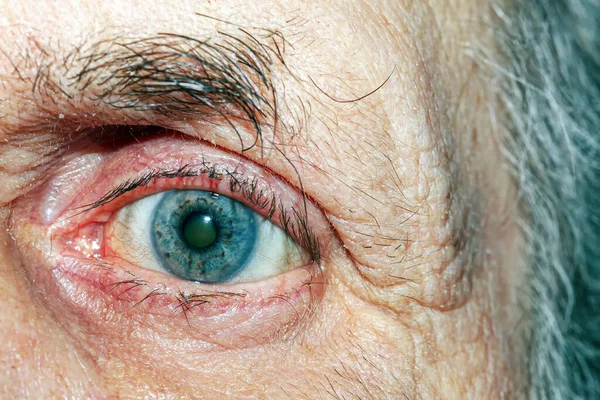 Eyes of an elderly man with glaucoma
