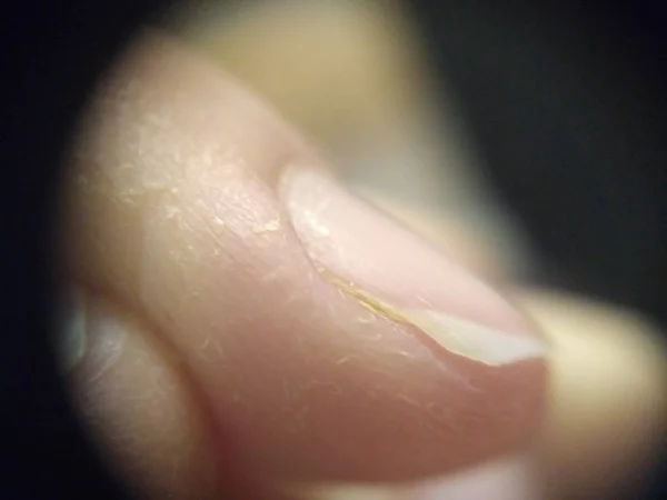 Dry Skin Cuticle Nail Fibers Macro Close Naked Nail Manucure — Stock Photo, Image