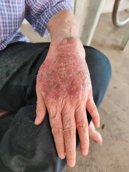 Close Dermatite Pele Velho Homem Asiático — Fotografia de Stock