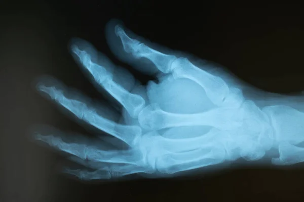 X-ray of the hand of an adult male with an injured finger. Selective focus. Blur. Noise, sharpness and grain are typical for X-rays. Horizontal orientation.